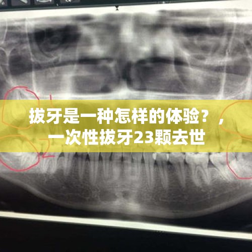 拔牙是一种怎样的体验？，一次性拔牙23颗去世