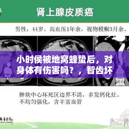 小时侯被地窝蜂蛰后，对身体有伤害吗？，智齿坏了要拔吗？会不会影响备孕？