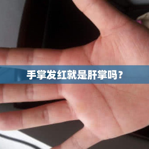 手掌发红就是肝掌吗？