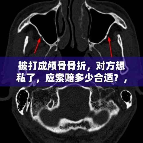 被打成颅骨骨折，对方想私了，应索赔多少合适？，打人骨折欲40万私了