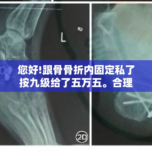 您好!跟骨骨折内固定私了按九级给了五万五。合理吗?如果不合理能通过法律途径要回来吗?农民工帮帮忙？，重病患者被人打了两处骨折私了50万多吗？