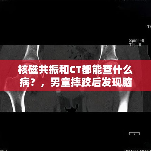 核磁共振和CT都能查什么病？，男童摔跤后发现脑瘤