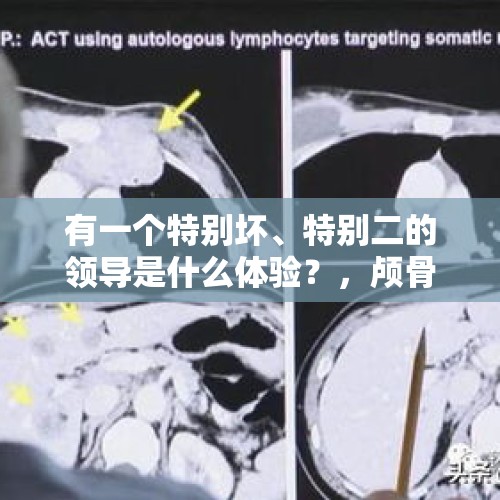 有一个特别坏、特别二的领导是什么体验？，颅骨恶性肿瘤会有生存的希望吗？